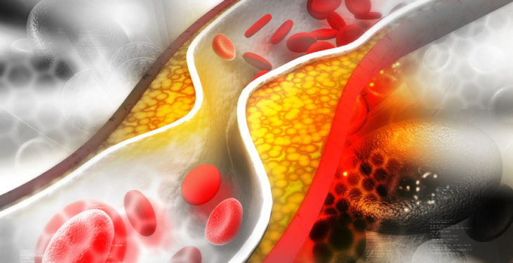 Cholesterol powodujący miażdżycę